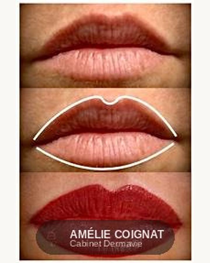 Transformation - Cabinet Dermavie Sainte-Maxime