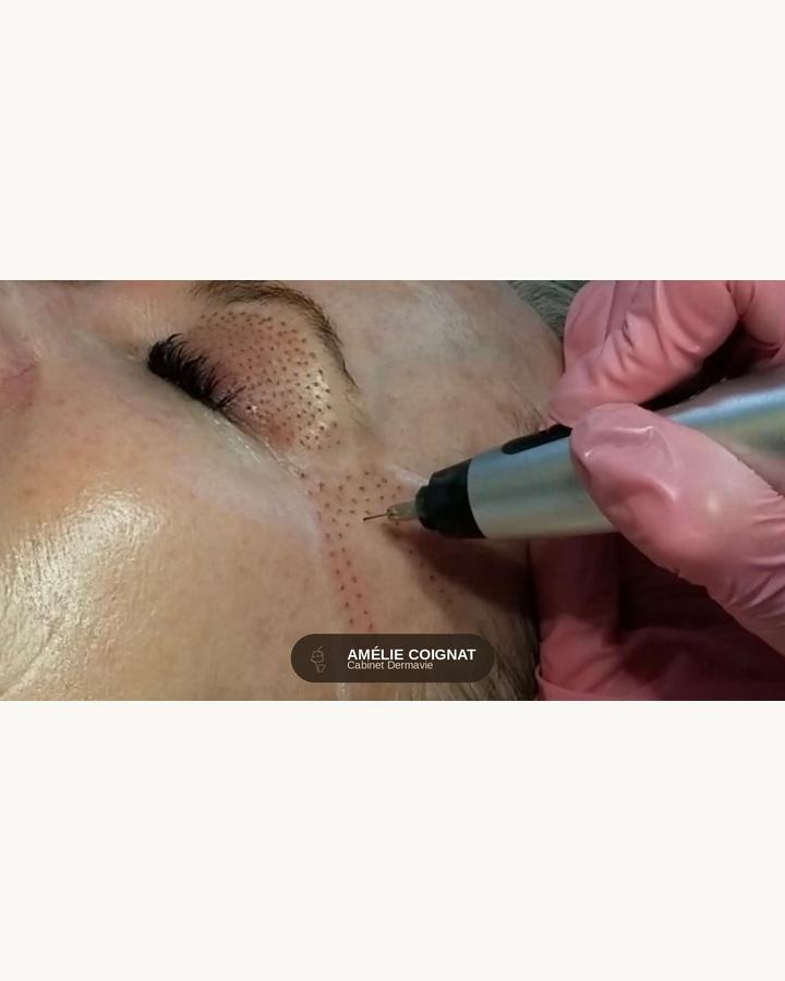 Plasma pen pattes doies geste - Cabinet Dermavie Sainte-Maxime