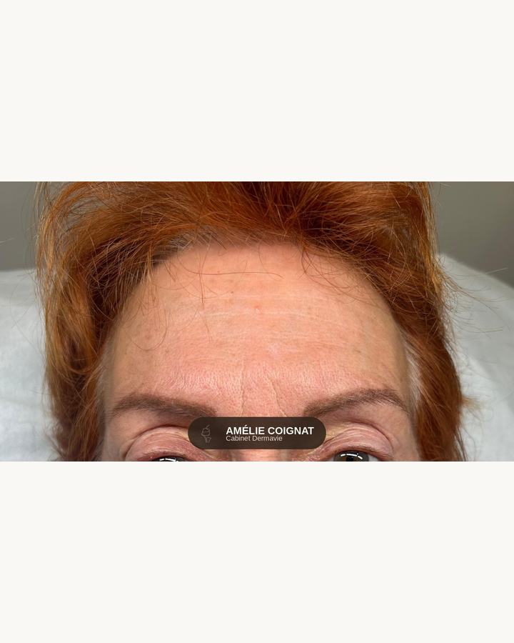 Cicatrise phototype clair - Cabinet Dermavie Sainte-Maxime