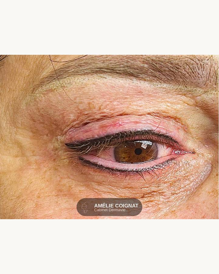 Liner peau mature resultat - Cabinet Dermavie Sainte-Maxime