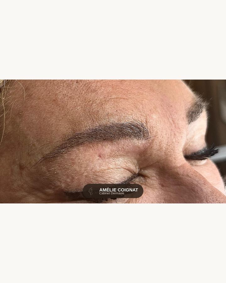 Microshading cicatrise - Cabinet Dermavie Sainte-Maxime